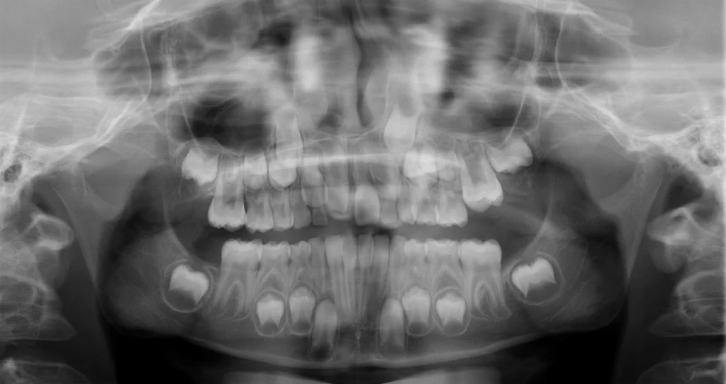 OPG snímka mliečneho a trvalého chrupu u detského pacienta.